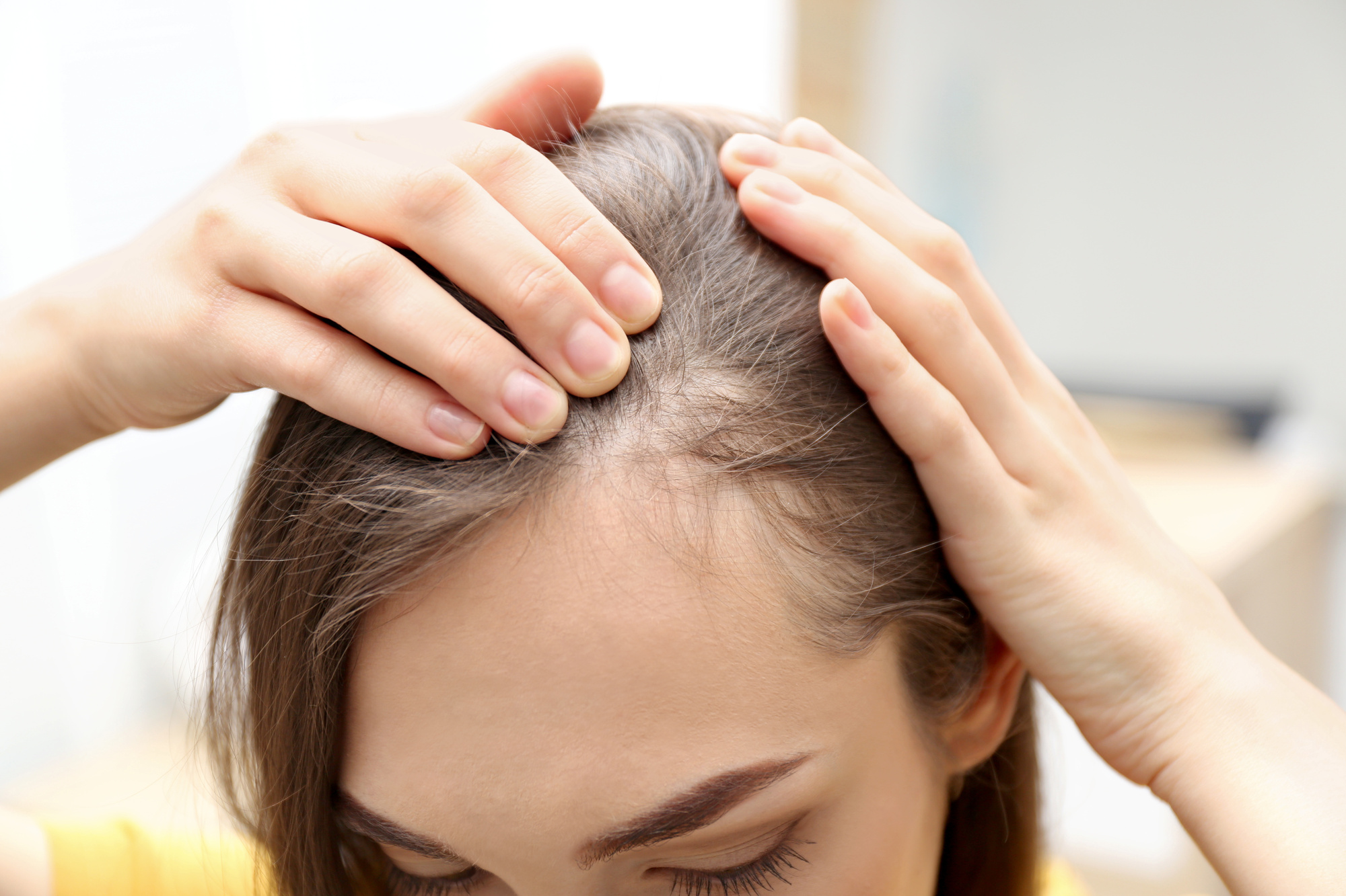 remedies for thinning hair
